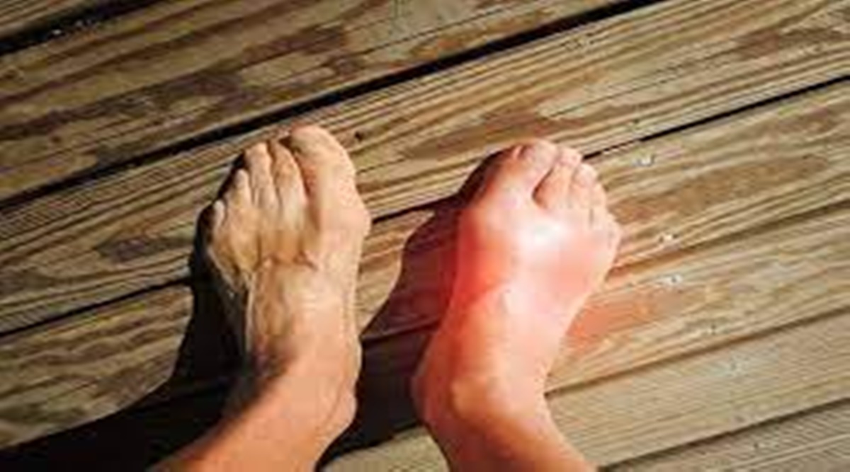 Burning feet sensation can be high uric acid symptom know other warning