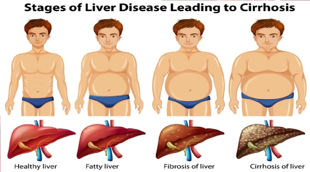 Should Ghee be eaten in Fatty Liver See complete list of food for fatty