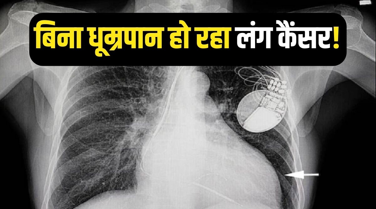 Lung Cancer cases in India Nonsmokers are also getting lung cancer