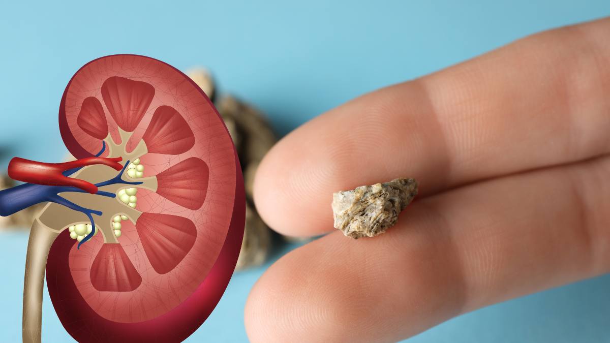 शरीर में होने वाले इन बदलावों को न करें नजरअंदाज, किडनी स्टोन की तरफ हो