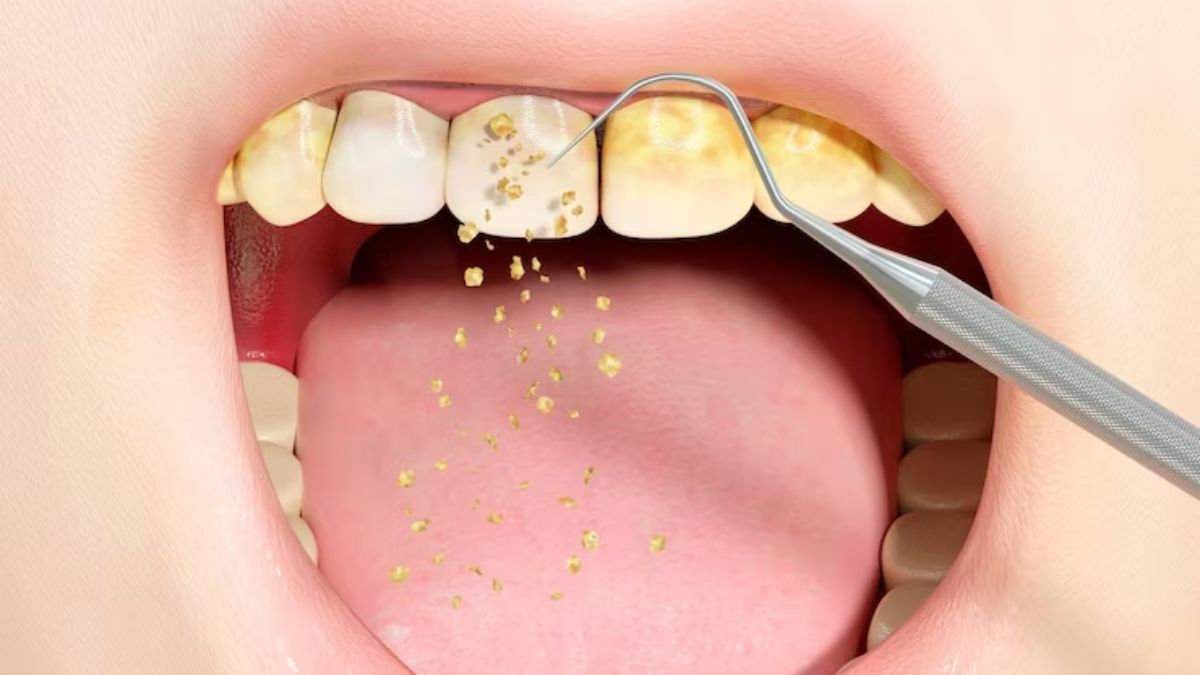 Teeth Whitening Tips know How to Get Rid of Yellow plaque on Teeth at Home  - दांतों पर जमे पीले प्लाक को जड़ से साफ कर देंगे ये देसी नुस्खे, 2-3 मिनट
