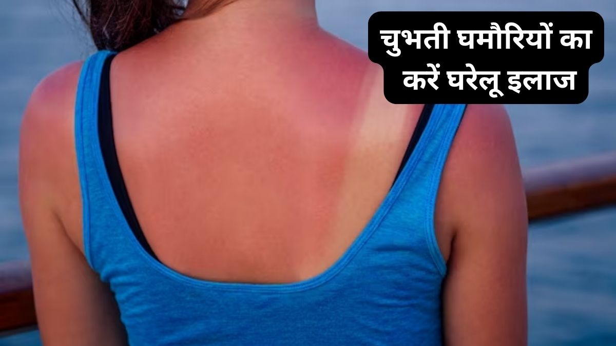 5 best way to get rid of prickly heat rash at hot summer,ghamoria home