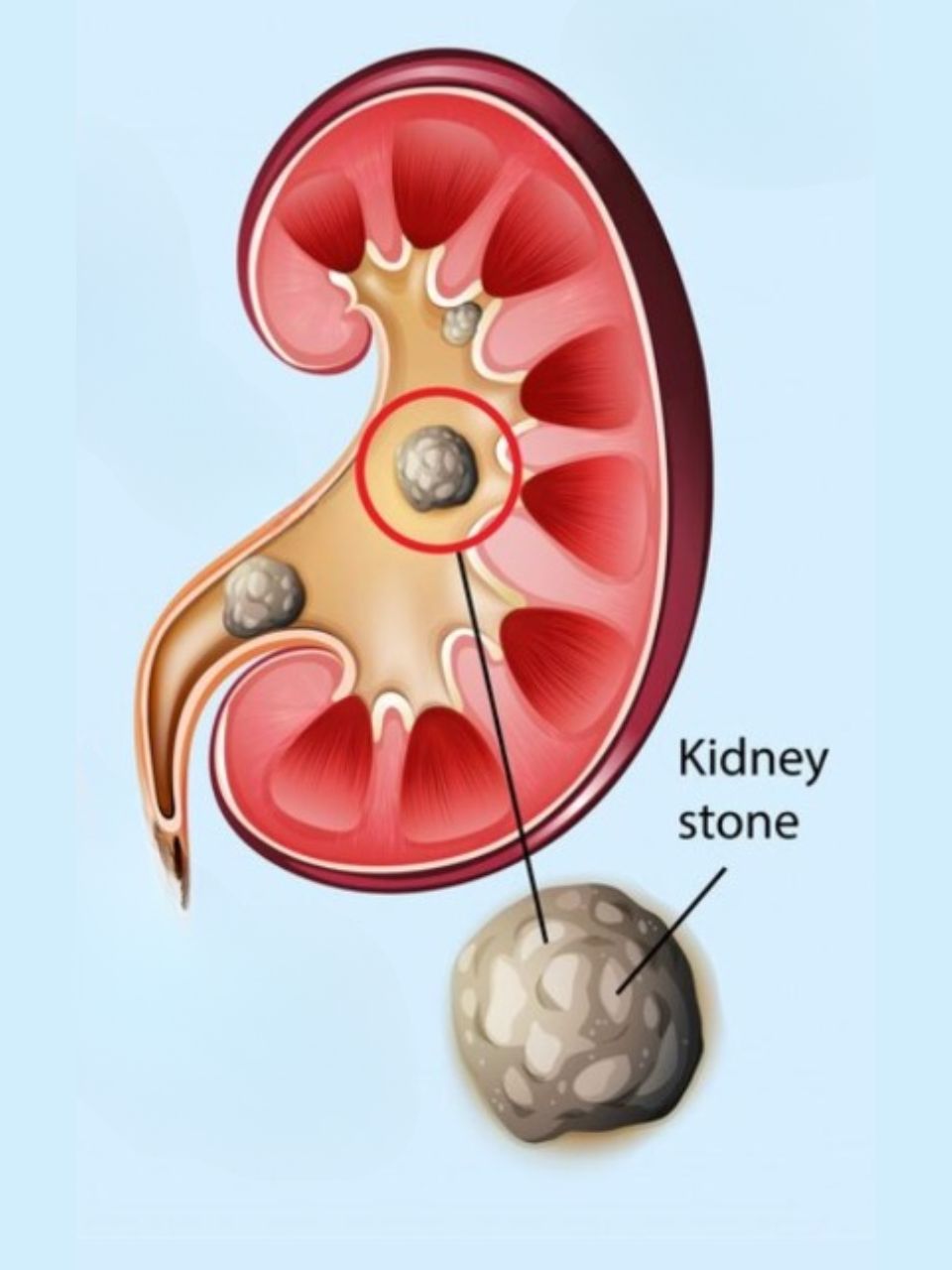 Does drinking beer really cure kidney stones